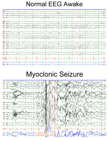 Juvenile Myoclonic Epilepsy Janz S Syndrome Symptoms Treatment