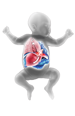 Congenital Diaphragmatic Hernia Defect