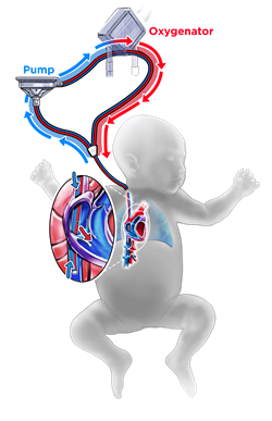 Congenital Diaphragmatic Hernia ECMO