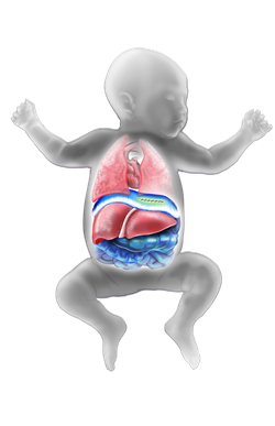 Congenital Diaphragmatic Hernia Repair