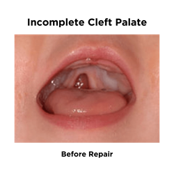Incomplete Cleft Palate