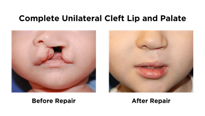 Complete Unilateral Cleft Lip and Palate