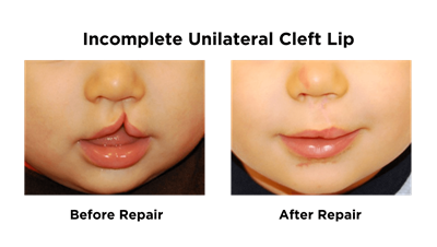 Incomplete Unilateral Cleft Lip