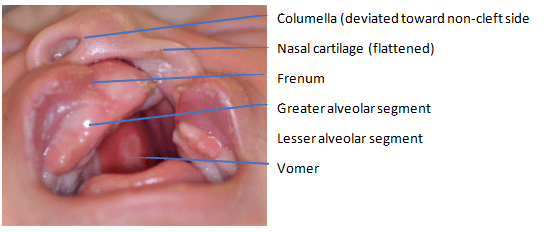 Nasoalveolar Molding