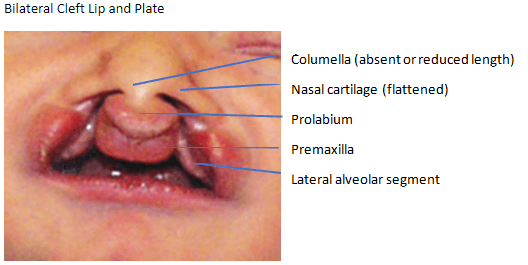 Nasoalveolar Molding