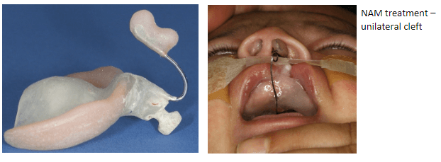 Nasoalveolar Molding