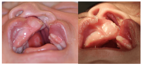 Nasoalveolar Molding