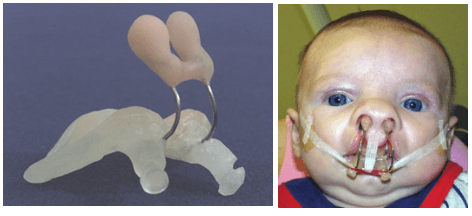 Nasoalveolar Molding