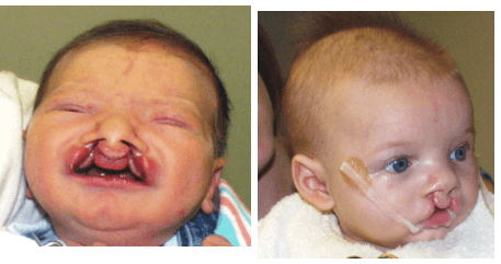 Nasoalveolar Molding