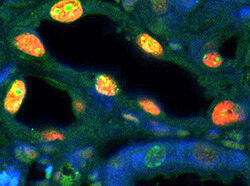 Chronic Kidney Disease