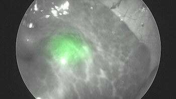 The use of indocyanine green (ICG) provides a fluorescent cue for identifying pulmonary nodules during thoracoscopic surgery